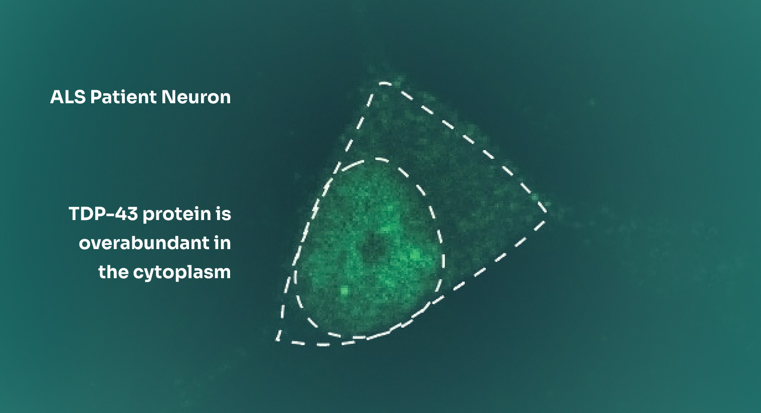 als_patient_neuron.jpg